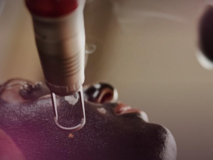 RF microneedling device on skin — clinical treatment close-up